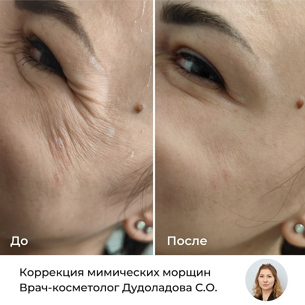 Уколы Ботокса (Botox) - сделать ...