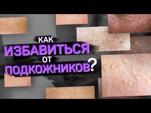 Карта лица: что хотят сказать прыщи?