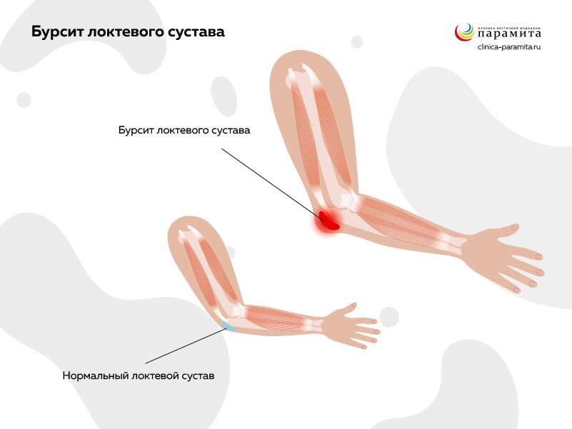 Базально-клеточная карцинома: код по ...