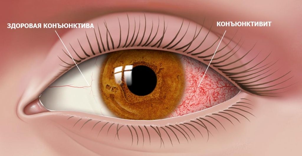 Как убрать синяки и темные круги под глазами у мужчин и ...