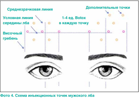 Ботокс цены. Ботокс отзывы. Как поднять брови ботоксом ...