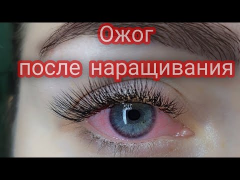 КРАСНЫЕ ГЛАЗА ПОСЛЕ НАРАЩИВАНИЯ РЕСНИЦ! ВСЕ ПРИЧИНЫ И КАК ...