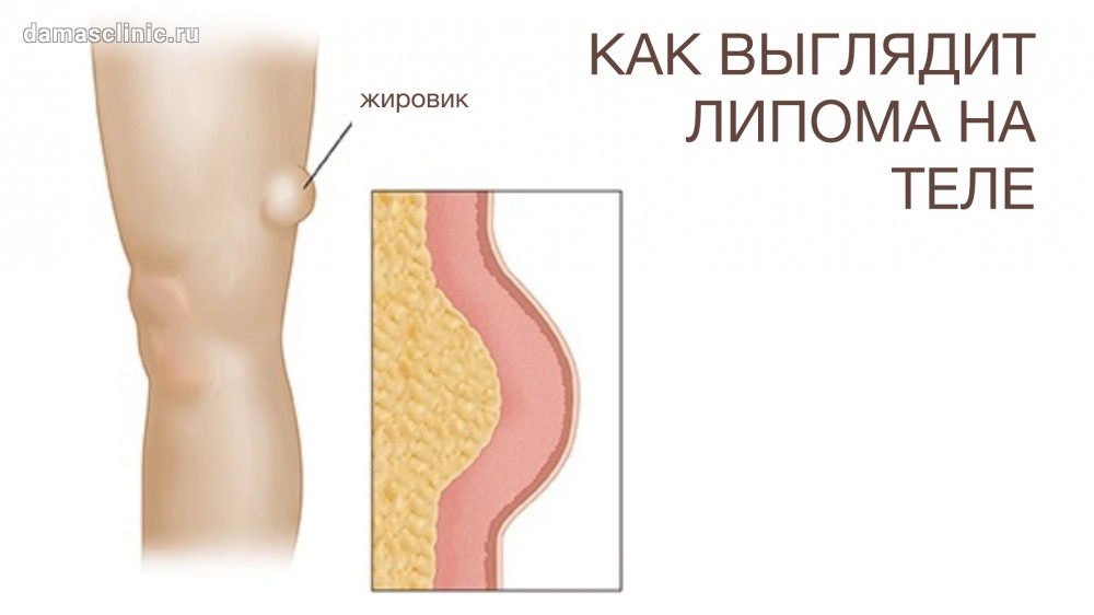 ᐅ Лазерное удаление липомы в Киеве ᐊ Цены и отзывы на ...