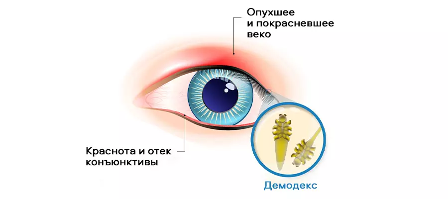 Анализ на демодекс. Соскоб на демодекс: когда назначается ...