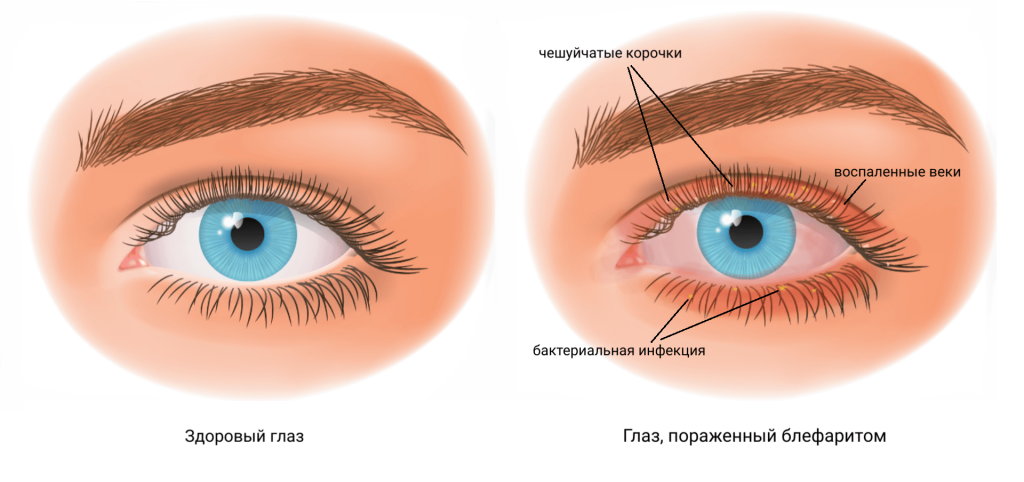 Демодекоз: симптомы, лечение и профилактика – Фитомаркет