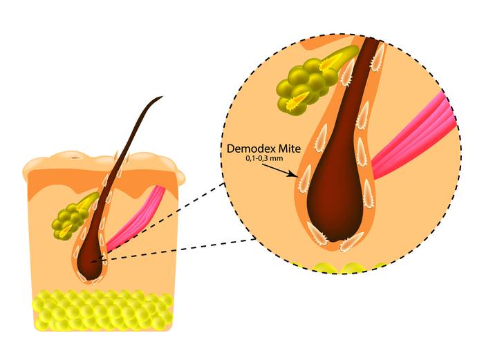 Демодекоз на лице: причины и методы лечения - Coolaser Clinic