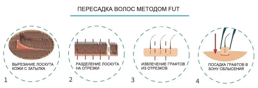 DHI или FUE? Какой метод пересадки волос лучше? | Estenbul Health