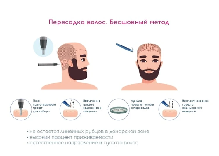 Современный метод пересадки волос без единого шва.