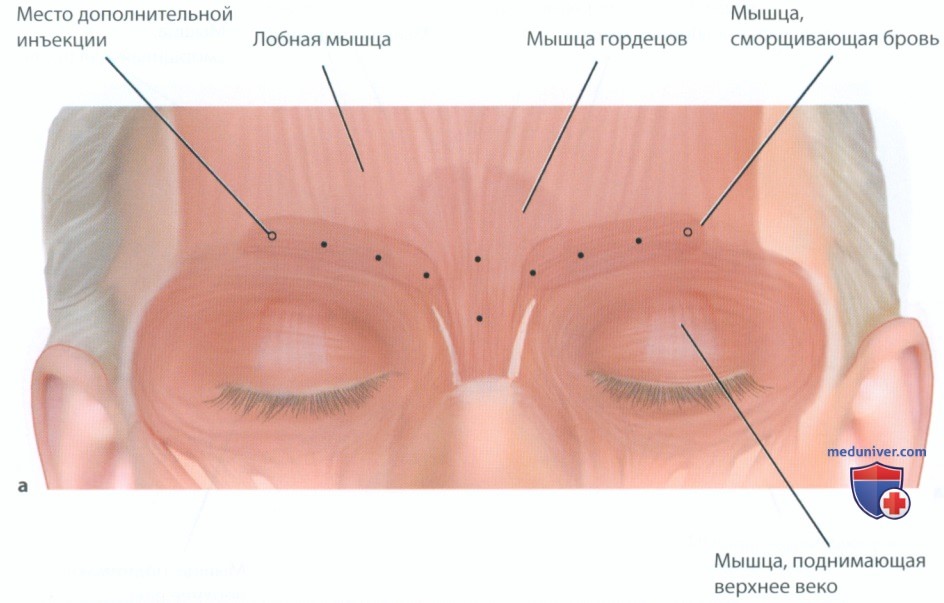1 упражнение, чтобы уменьшить выраженность межбровных морщин ...
