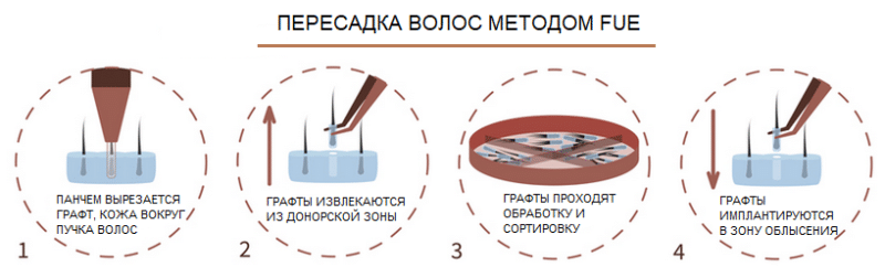 Пересадка волос DHI - TravelMEDI