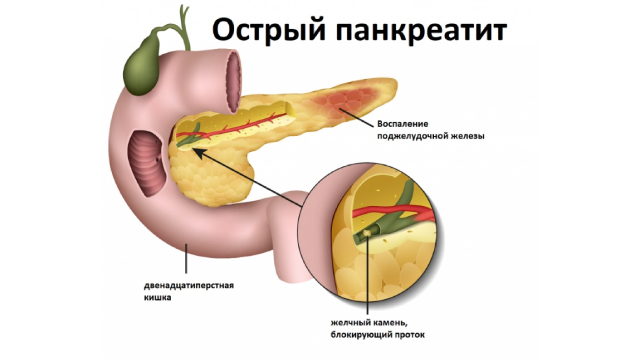 Функциональные нарушения поджелудочной железы у детей: как ...