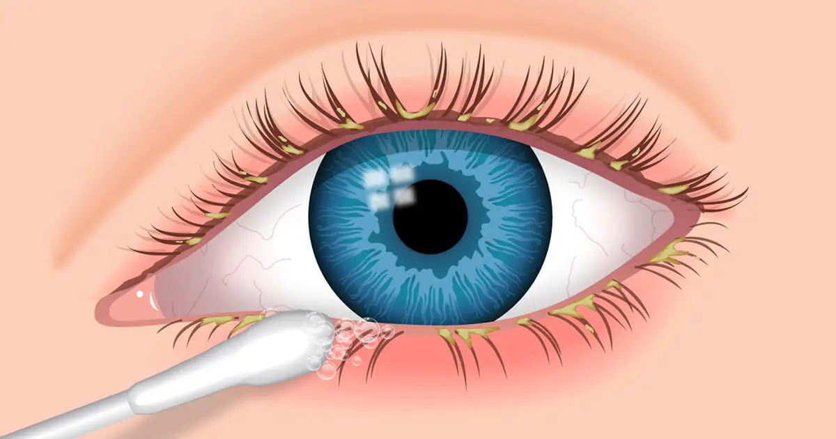 Блефарит: симптомы, причины, способы лечения - Prodex