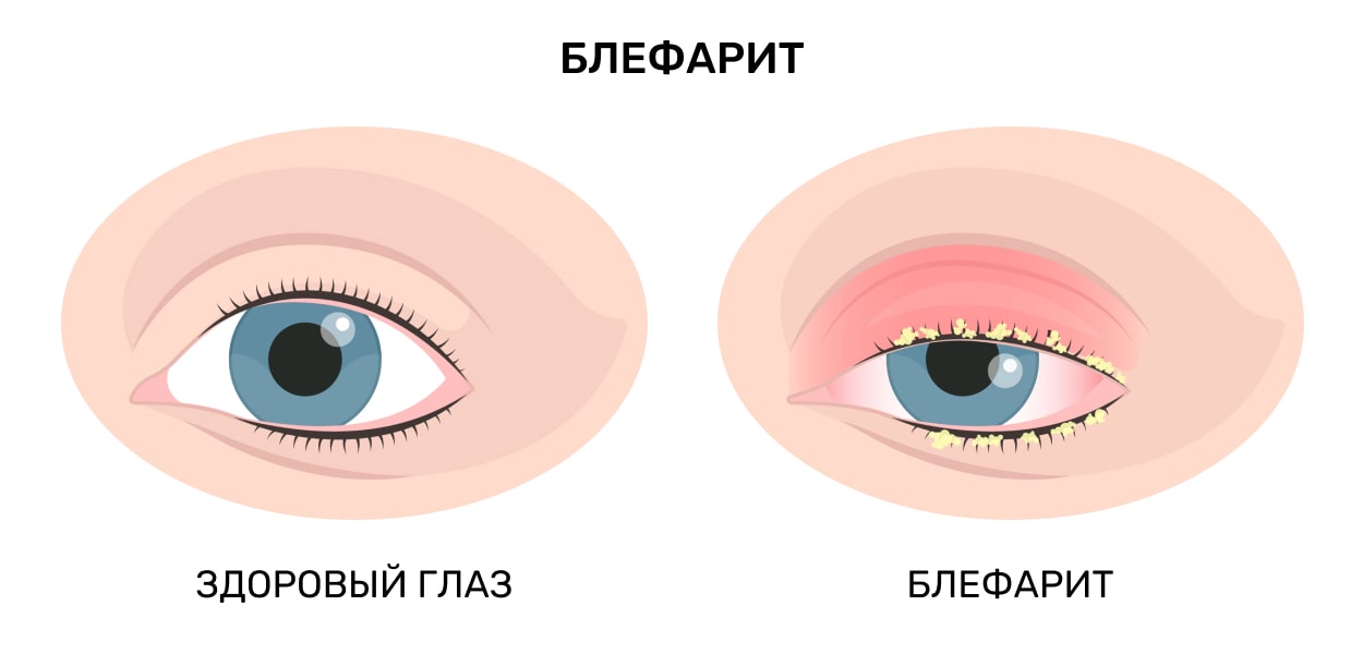 Вросшие ресницы - Центр Хирургии Глаза