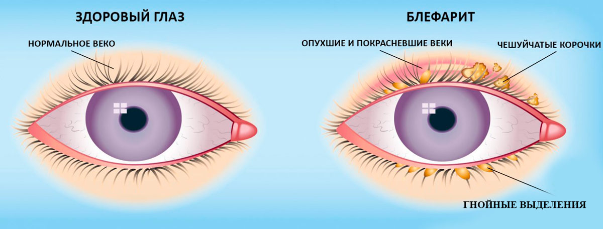 БЛЕФАРОГЕЛЬ -2 гель 15мл (флакон) N1 ...