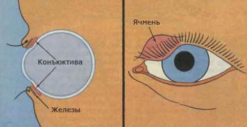 Что такое халязион и ячмень? - Latvijas ...