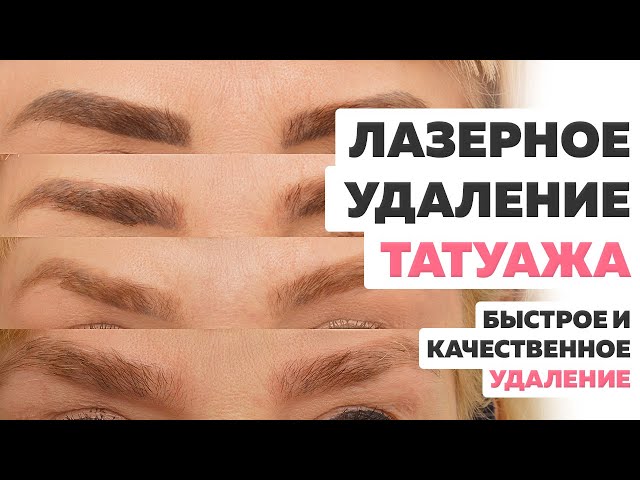 Удаление татуажа бровей лазером – все об особенностях процедуры