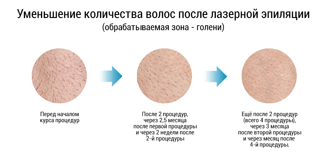 Лазерная эпиляция диодным лазером в Пятигорске