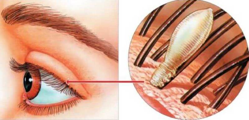От глазного клеща практически невозможно избавиться
