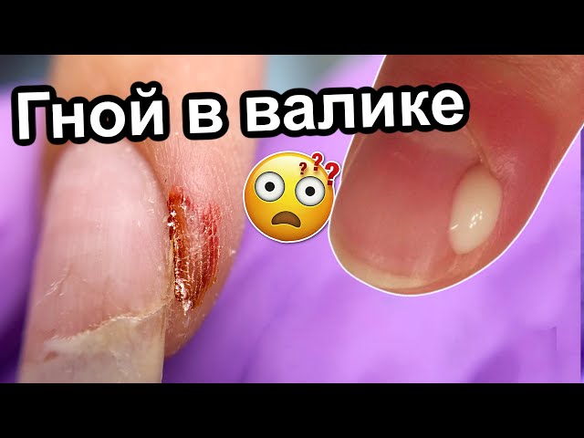 Как Убрать Гной В Боковой Части Ногтя | TikTok