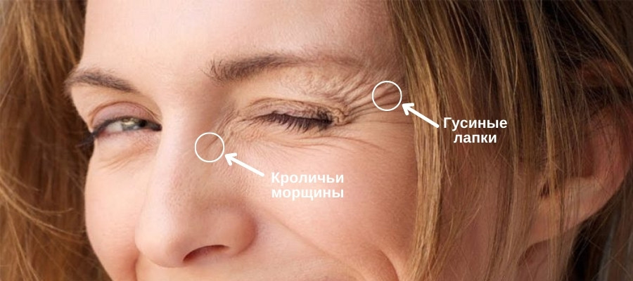 Устранение морщин (Botox, Dysport) в ...