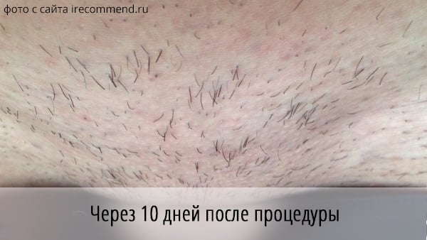 Мезотерапия - Лечение волос – Lux Medicus