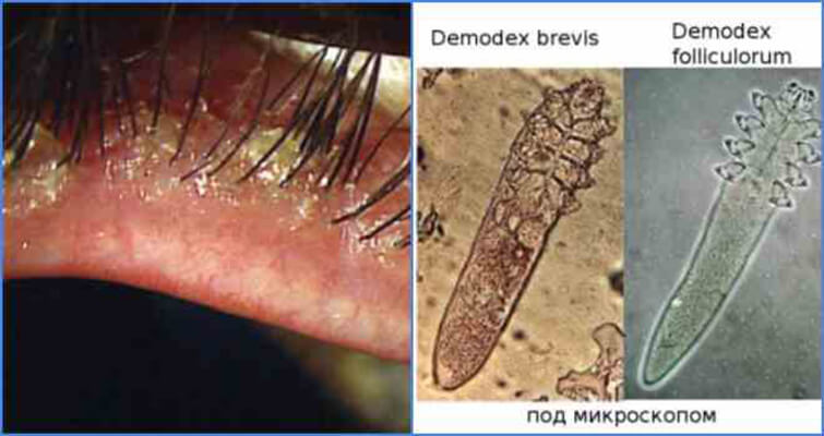 Анализ на демодекс. Соскоб на демодекс: когда назначается ...