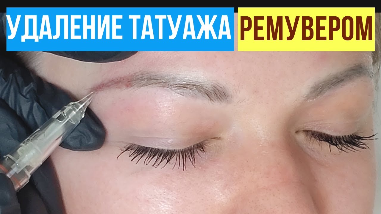 Удаление Татуажа Ремувером Отзывы | Результаты Процедуры