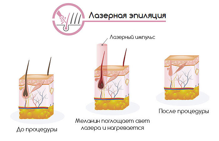 Электроэпиляция - эффективный способ ...