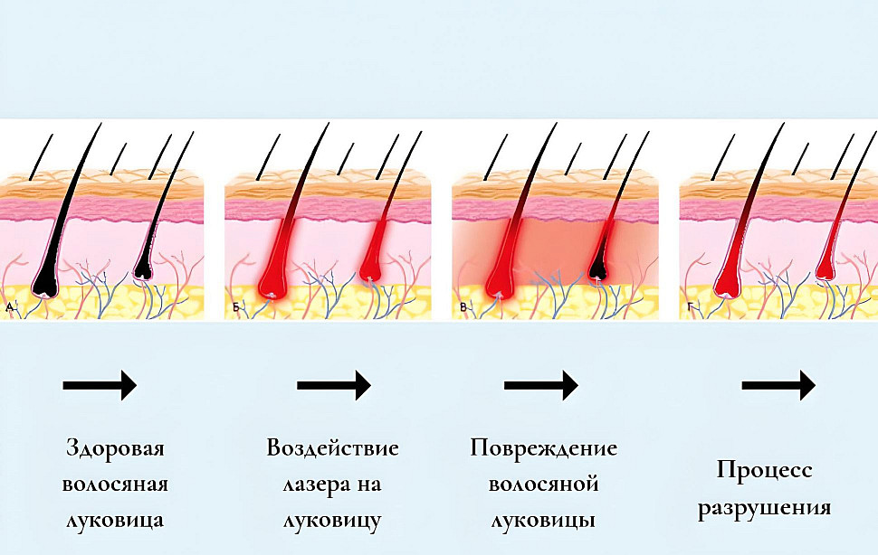 Депиляция сахаром - процедура шугаринга ...