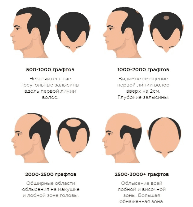 Делать ли пересадку волос при алопеции📌 - статьи экспертов ...