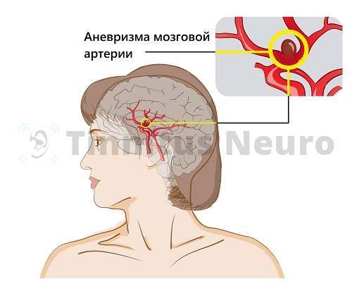 Психосоматика головной боли + аффирмация