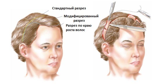 До и после: почему Белла Хадид, Кендалл ...