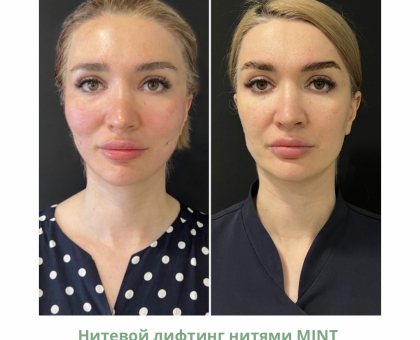 Нитевой лифтинг бровей. Миф или реальность? - Beauty Expert