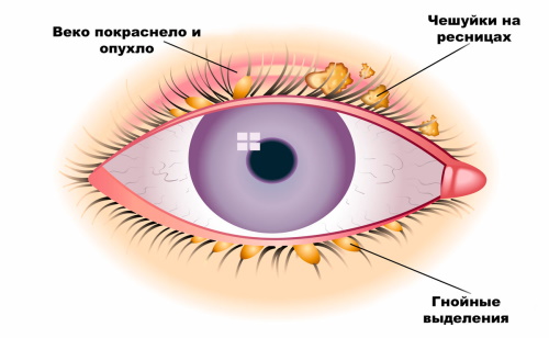 Красные глаза после наращивания ресниц, что делать ...