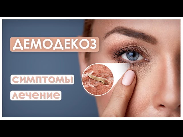 Почему возникает демодекоз | Блог ...