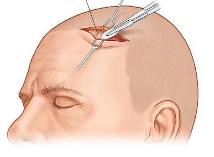 Эндоскопический лифтинг лба и бровей. Пластическая хирургия