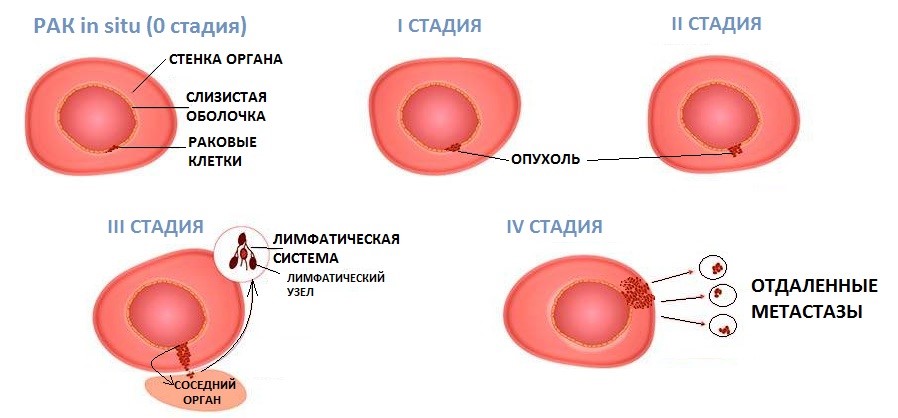 Опухоли яичников (кисты и кистомы): что это, симптомы ...