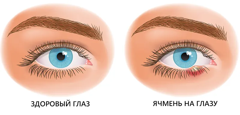 Боль в одном глазу: причины, что с этим делать