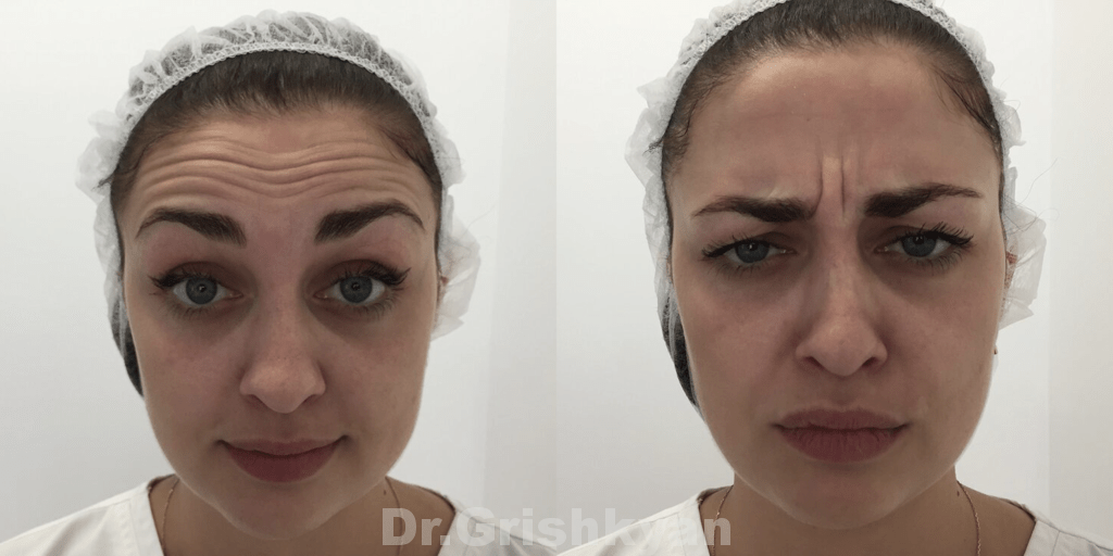 Ботокс в технике Brow LIFT - это значит , что у вас не будет ...