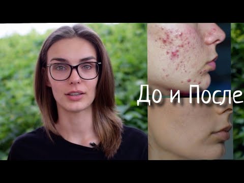 Акнекутан капсулы 8мг №30, цены от 0 ₽, купить в Самаре ...